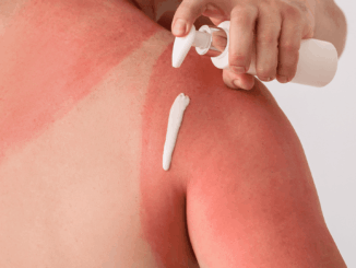 Woman putting lotion on her sunburned shoulder