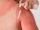Woman putting lotion on her sunburned shoulder