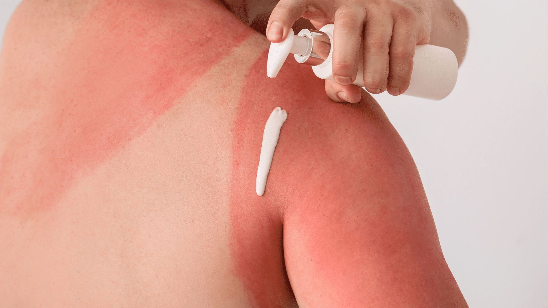 Woman putting lotion on her sunburned shoulder